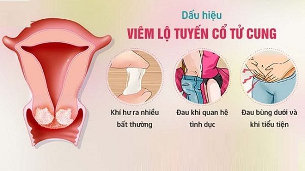 4 biểu hiện viêm lộ tuyến cổ tử cung dễ nhận biết nhất