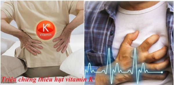 Triệu chứng thiếu hụt vitamin K, cảnh báo bệnh gì, giải pháp