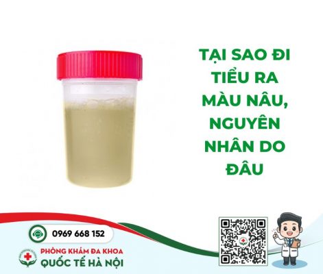 Tiểu Ra Màu Nâu Có Nguy Hiểm Không? Giải Mã Bí Ẩn Và Giải Pháp Hiệu Quả